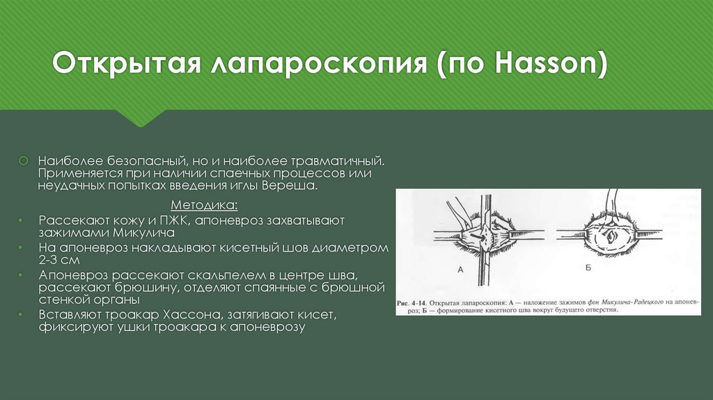 Открой метод. Введение троакара по Хассону. Метод Хассона лапароскопия. Открытый доступ по Хассону.