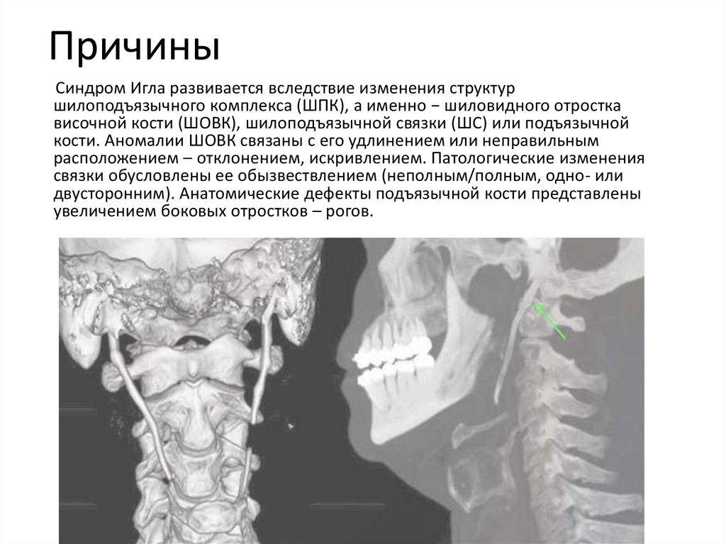 Шилоподъязычный синдром или синдром Игла-Стерлинга - online presentation
