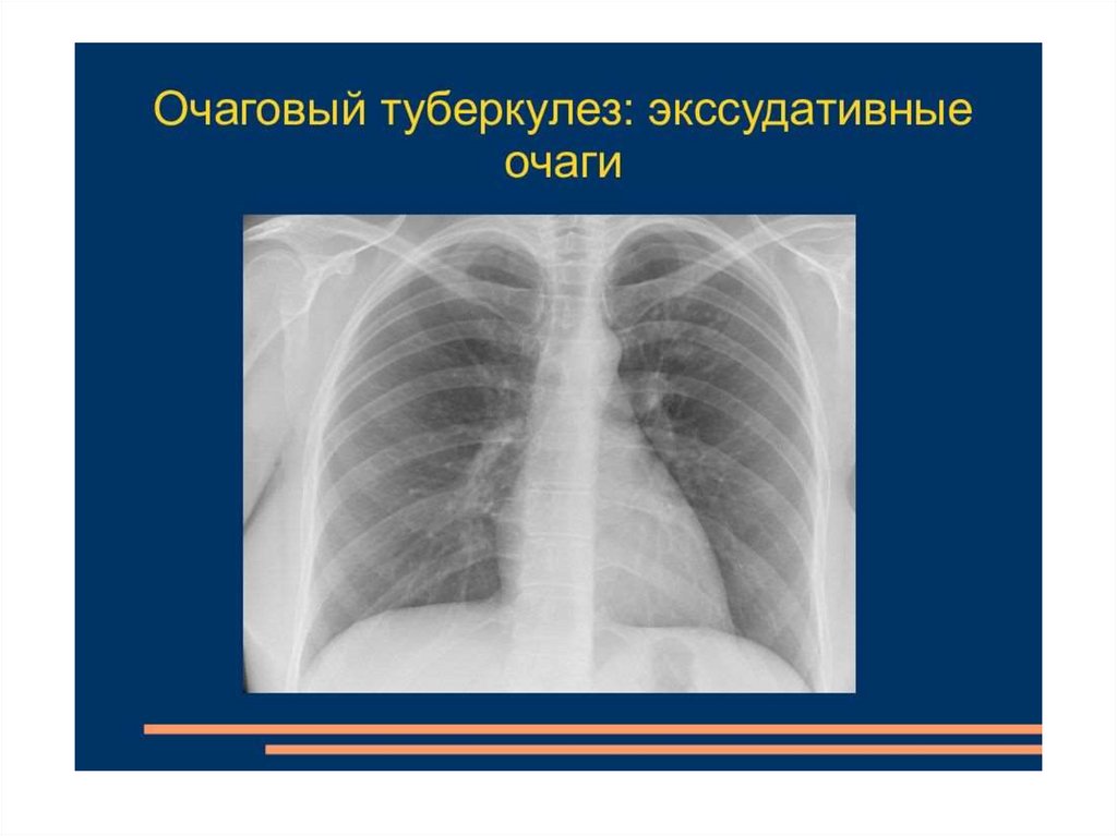 Очаговый туберкулез. Очаговый туберкулёз лёгкого рентген. Очаговая форма туберкулеза рентген. Очаговый туберкулез рентген кт. Острый очаговый туберкулез рентген.