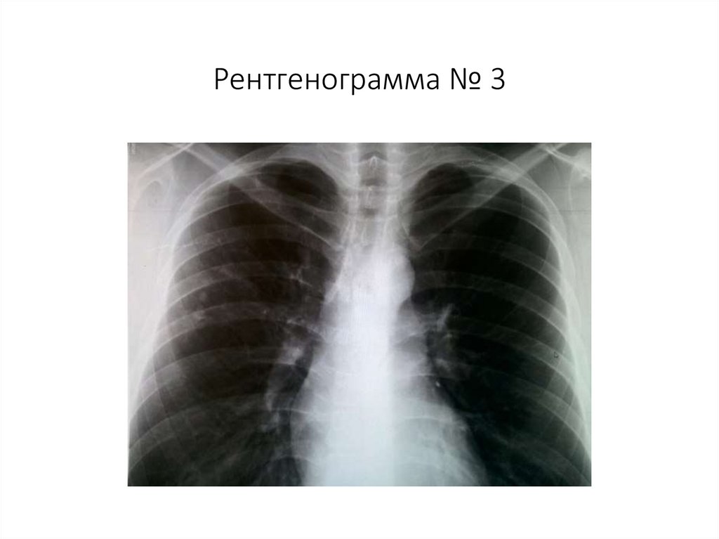Рентгенограмма № 3