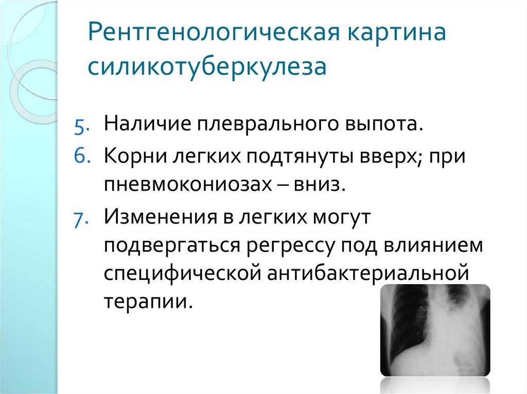 Рентгенологическая картина силикотуберкулеза