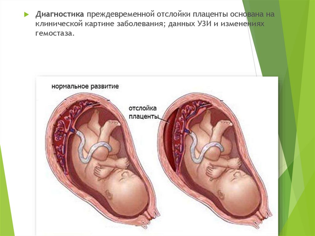 Тонус матки третий триместр. Отслойка плаценты в норме. Отслойка нормально расположенной плаценты.