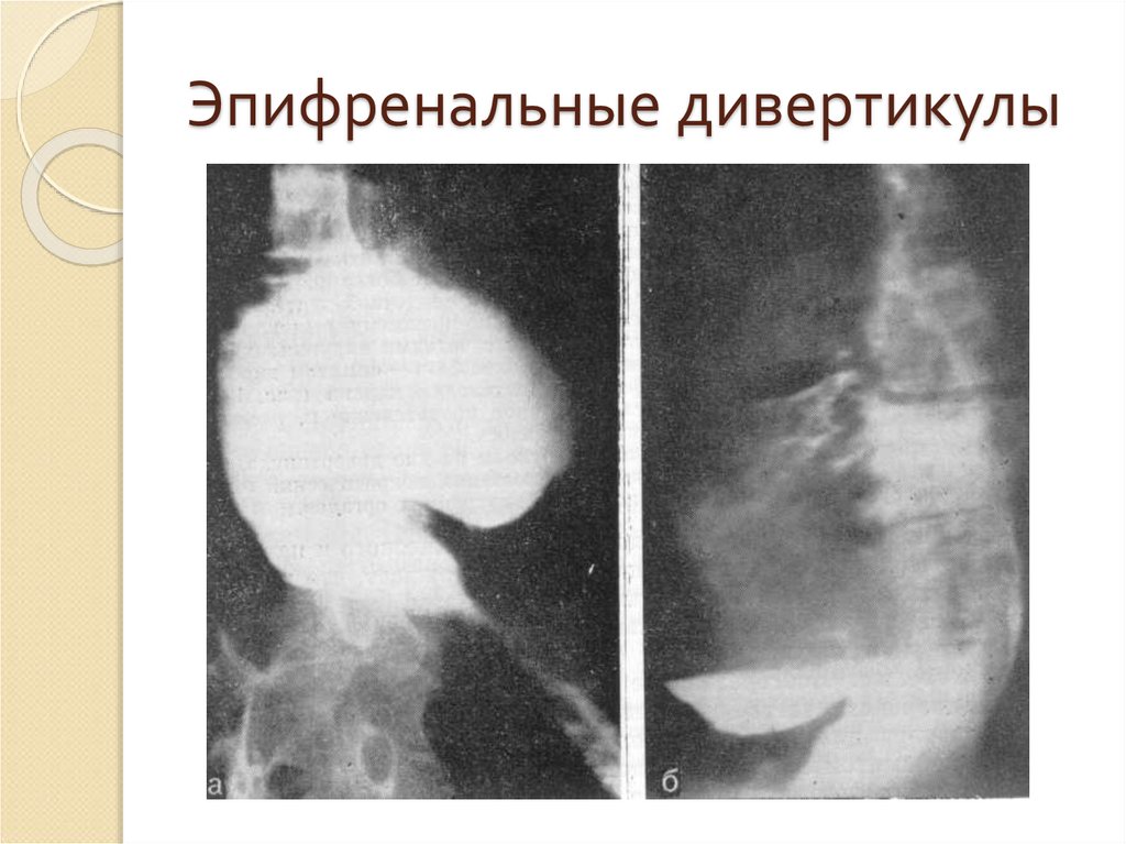 Дивертикулит пищевода