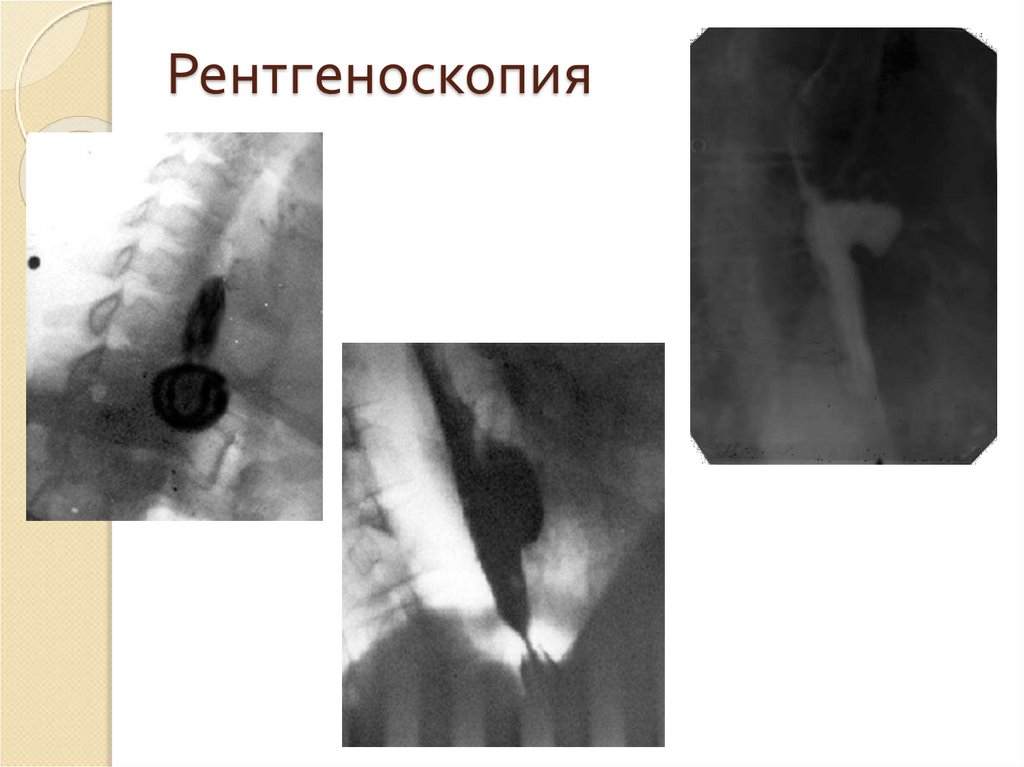 При рентгеноскопии изображение внутренних органов