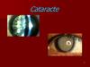 Cataracte