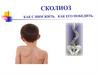 Сколиоз, как с ним жить и как его победить
