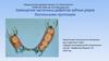 Замещение частичных дефектов зубных рядов бюгельными протезами