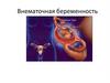 Внематочная беременность