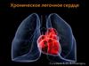 Хроническое легочное сердце