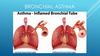 Bronchial asthma