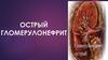 Острый гломерулонефрит