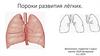 Пороки развития лёгких