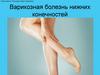 Варикозная болезнь нижних конечностей