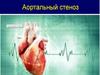 Аортальный стеноз