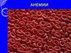 Анемии
