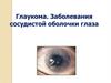 Глаукома. Заболевания сосудистой оболочки глаза
