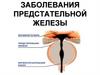 Заболевания предстательной железы