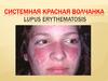 Системная красная волчанка