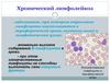 Хронический лимфолейкоз