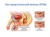 Рак предстательной железы