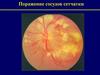 Поражение сосудов сетчатки