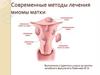 Современные методы лечения миомы матки
