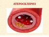 Атеросклероз
