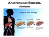 Алкогольная болезнь печени