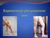 Варикозное расширение вен