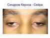 Синдром Кернса - Сейра