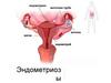 Эндометриозы