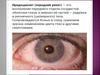 Иридоциклит (передний увеит)