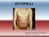 Псориаз (чешуйчатый лишай, psoriasis vulgaris)