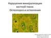 Нарушения минерализации костной ткани. Остеопороз и остеопения