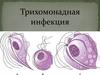 Трихомонадная инфекция