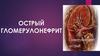 Острый гломерулонефрит. Острый гломерулонефрит
