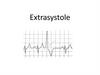 Extrasystole and blocks