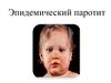 Эпидемический паротит