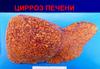 Цирроз печени